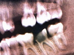 В лапах древнего дантиста: как наши предки сверлили зубы