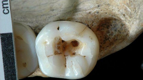 Этот человек 14 тысяч лет назад явно посещал первобытного дантиста